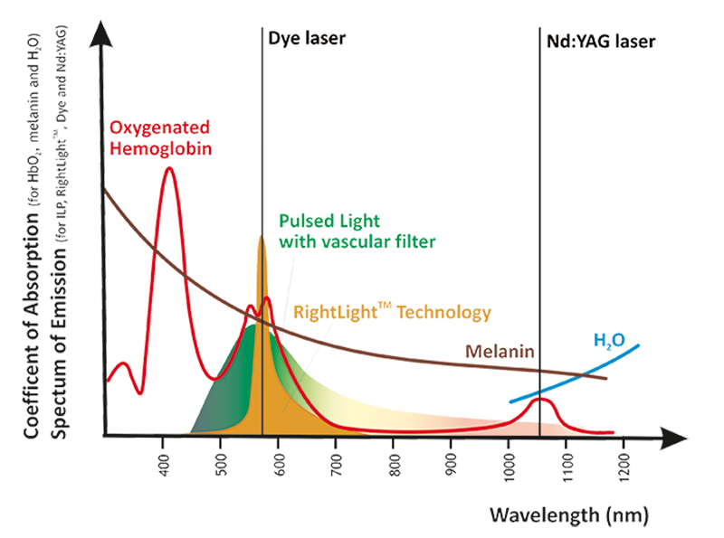 Laser-treatments-for-vascular-lesions-DEKA-Technologies1